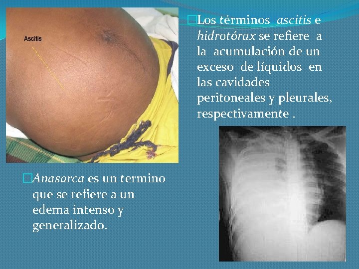 �Los términos ascitis e hidrotórax se refiere a la acumulación de un exceso de