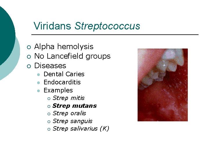 Viridans Streptococcus ¡ ¡ ¡ Alpha hemolysis No Lancefield groups Diseases l l l