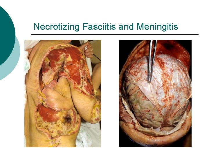 Necrotizing Fasciitis and Meningitis 