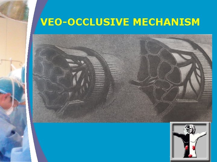 VEO-OCCLUSIVE MECHANISM COMPANY LOGO 