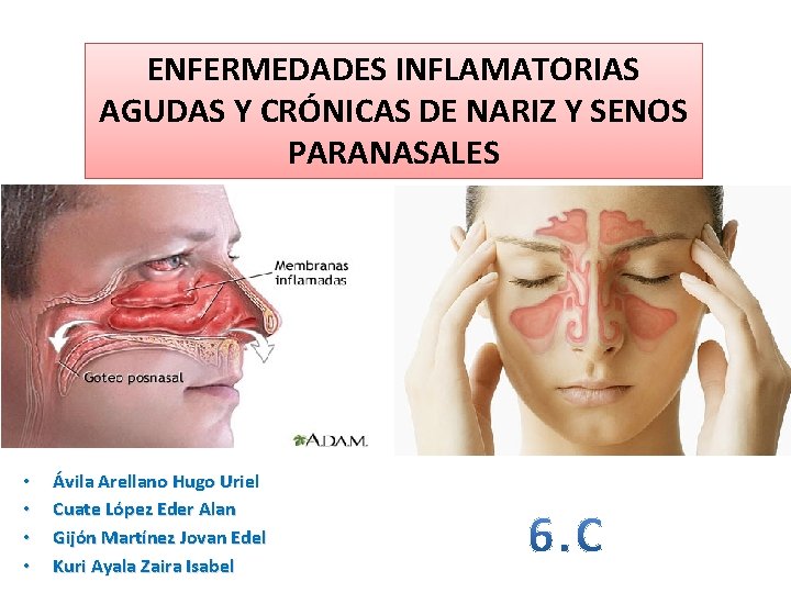 ENFERMEDADES INFLAMATORIAS AGUDAS Y CRÓNICAS DE NARIZ Y SENOS PARANASALES • • Ávila Arellano