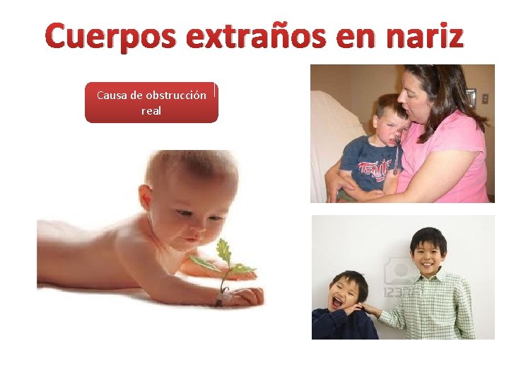 Cuerpos extraños en nariz Causa de obstrucción real 