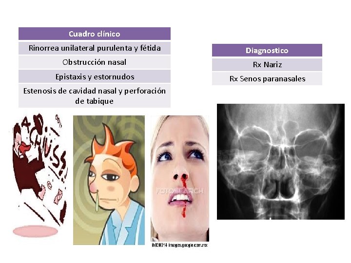 Cuadro clínico Rinorrea unilateral purulenta y fétida Diagnostico Obstrucción nasal Rx Nariz Epistaxis y