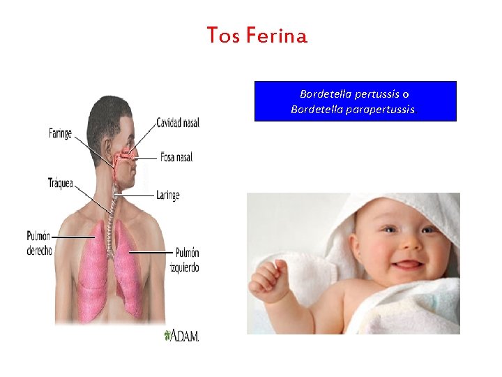Tos Ferina Bordetella pertussis o Bordetella parapertussis. 