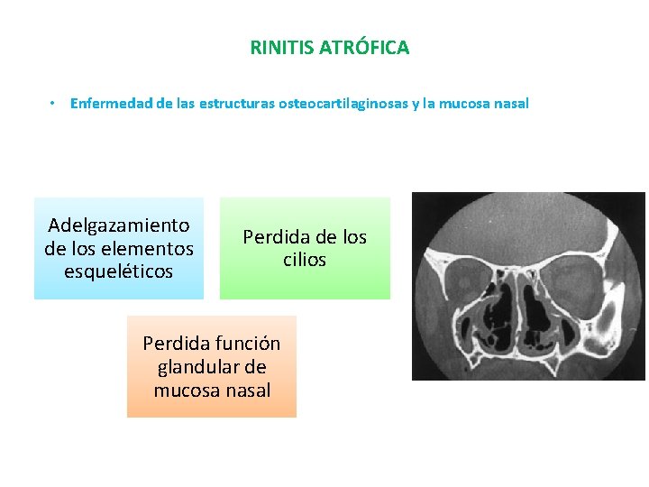 RINITIS ATRÓFICA • Enfermedad de las estructuras osteocartilaginosas y la mucosa nasal Adelgazamiento de