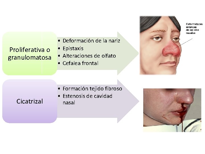  • Proliferativa o • granulomatosa • • Cicatrizal Deformación de la nariz Epistaxis