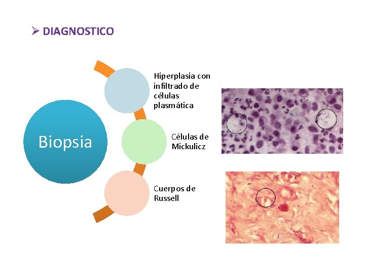 Ø DIAGNOSTICO Hiperplasia con infiltrado de células plasmática Biopsia Células de Mickulicz Cuerpos de