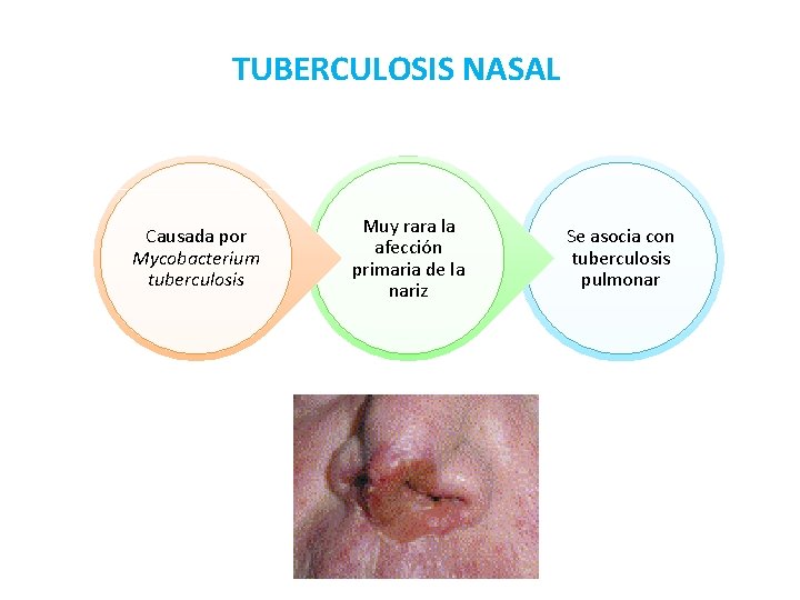 TUBERCULOSIS NASAL Causada por Mycobacterium tuberculosis Muy rara la afección primaria de la nariz