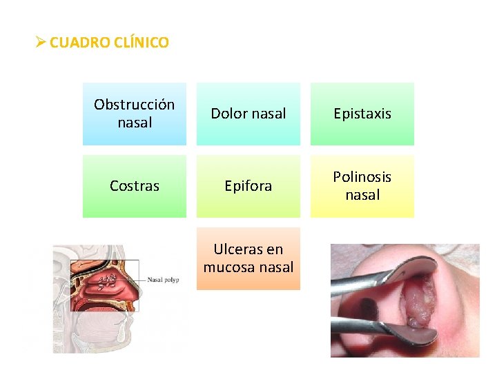Ø CUADRO CLÍNICO Obstrucción nasal Dolor nasal Epistaxis Costras Epifora Polinosis nasal Ulceras en