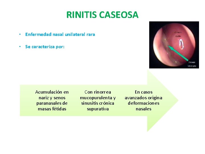 RINITIS CASEOSA • Enfermedad nasal unilateral rara • Se caracteriza por: Acumulación en nariz