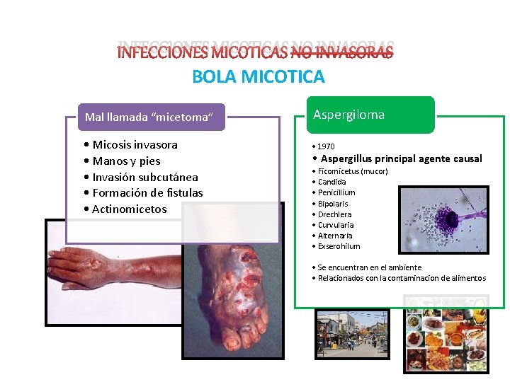 INFECCIONES MICOTICAS NO INVASORAS BOLA MICOTICA Mal llamada “micetoma” • Micosis invasora • Manos
