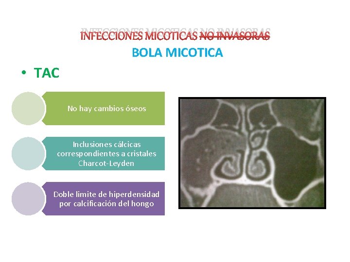 INFECCIONES MICOTICAS NO INVASORAS BOLA MICOTICA • TAC No hay cambios óseos Inclusiones cálcicas