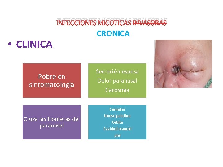 INFECCIONES MICOTICAS INVASORAS • CLINICA Pobre en sintomatología CRONICA Secreción espesa Dolor paranasal Cacosmia