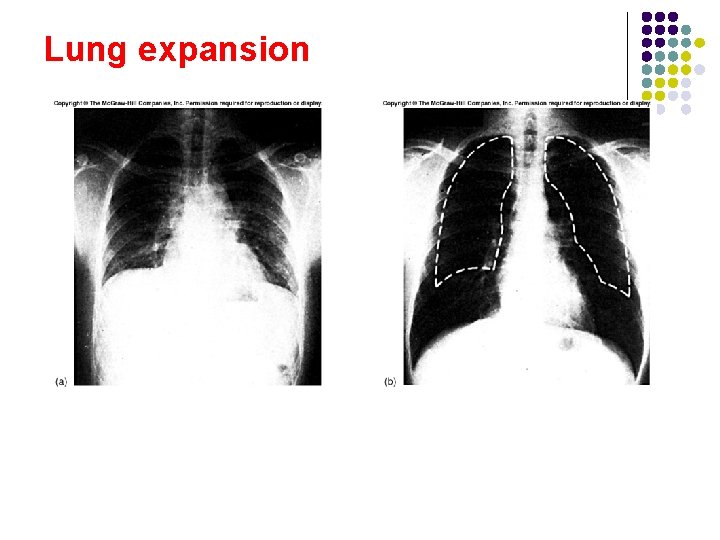 Lung expansion Lung expansion