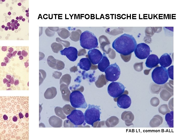 ACUTE LYMFOBLASTISCHE LEUKEMIE FAB L 1, common B-ALL 