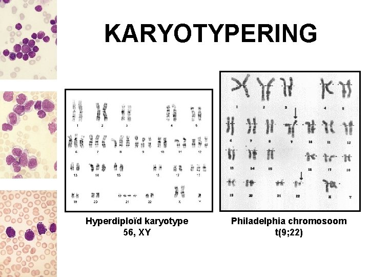 KARYOTYPERING Hyperdiploïd karyotype 56, XY Philadelphia chromosoom t(9; 22) 