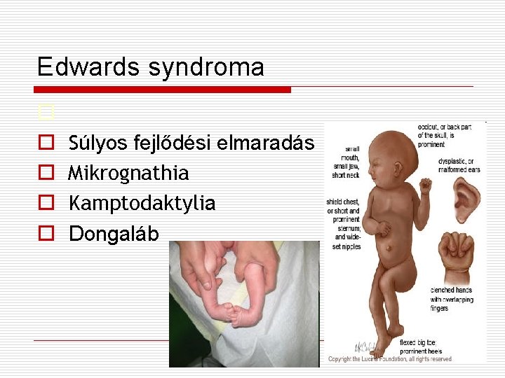 Edwards syndroma o o o Súlyos fejlődési elmaradás Mikrognathia Kamptodaktylia Dongaláb 