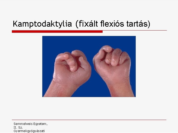 Kamptodaktylia (fixált flexiós tartás) Semmelweis Egyetem, II. Sz. Gyermekgyógyászati 