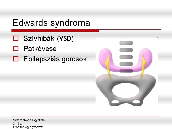 Edwards syndroma o Szívhibák (VSD) o Patkóvese o Epilepsziás görcsök Semmelweis Egyetem, II. Sz.