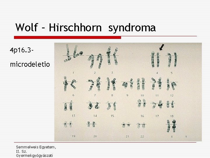 Wolf – Hirschhorn syndroma 4 p 16. 3 microdeletio Semmelweis Egyetem, II. Sz. Gyermekgyógyászati