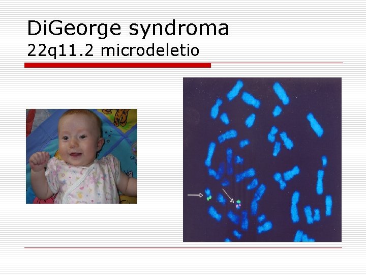 Di. George syndroma 22 q 11. 2 microdeletio 