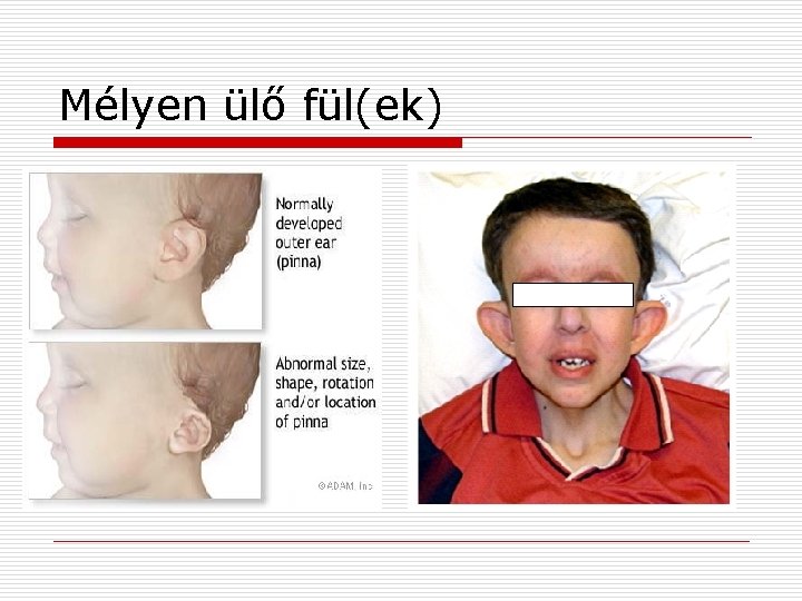 Mélyen ülő fül(ek) 