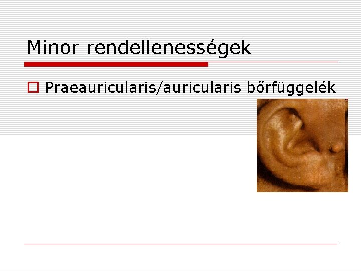 Minor rendellenességek o Praeauricularis/auricularis bőrfüggelék 