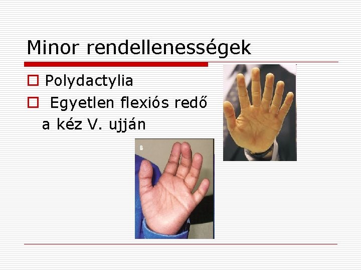 Minor rendellenességek o Polydactylia o Egyetlen flexiós redő a kéz V. ujján 