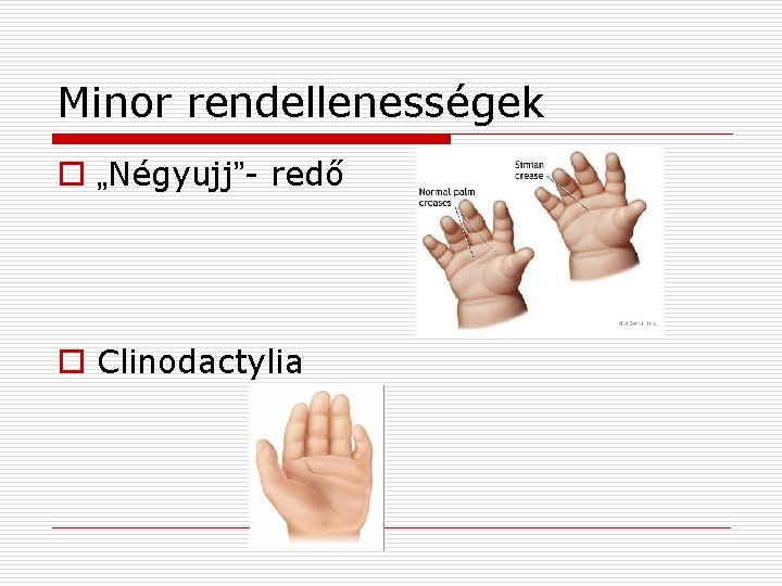 Minor rendellenességek o „Négyujj”- redő o Clinodactylia 