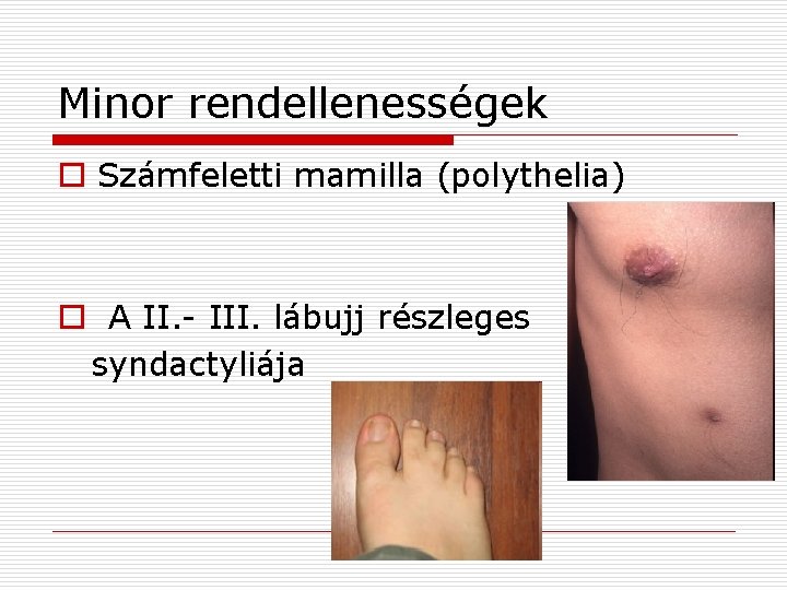 Minor rendellenességek o Számfeletti mamilla (polythelia) o A II. - III. lábujj részleges syndactyliája