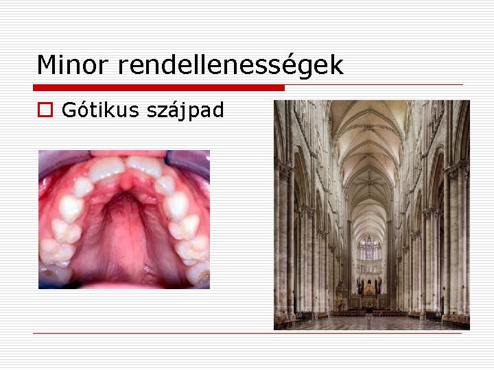 Minor rendellenességek o Gótikus szájpad 