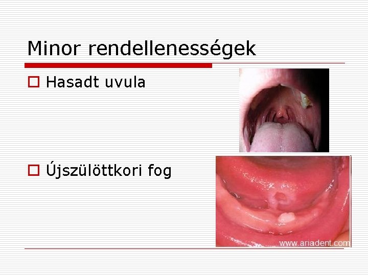 Minor rendellenességek o Hasadt uvula o Újszülöttkori fog 