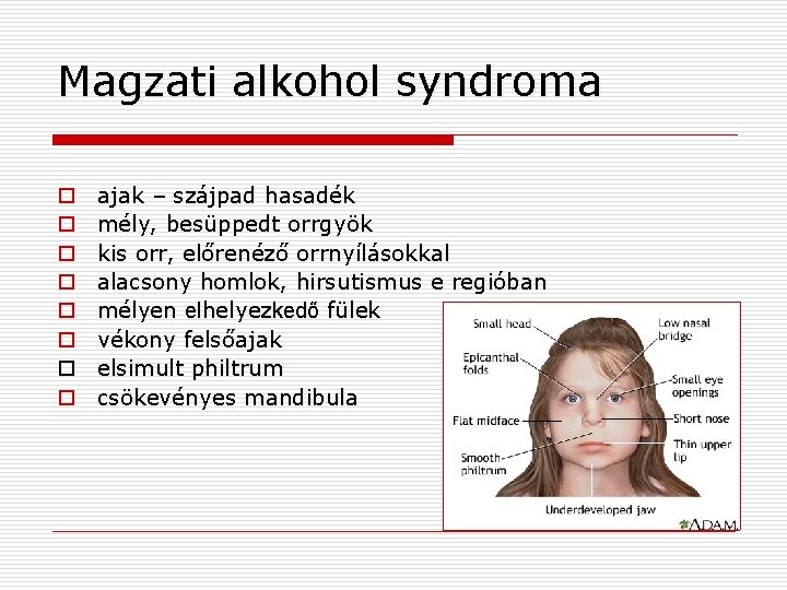 Magzati alkohol syndroma o o o o ajak – szájpad hasadék mély, besüppedt orrgyök