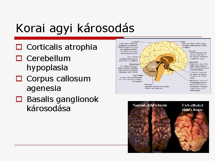 Korai agyi károsodás o Corticalis atrophia o Cerebellum hypoplasia o Corpus callosum agenesia o