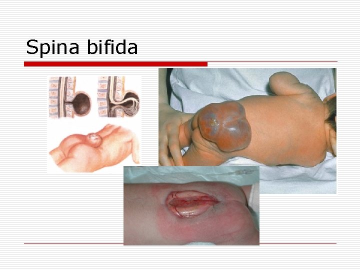 Spina bifida 