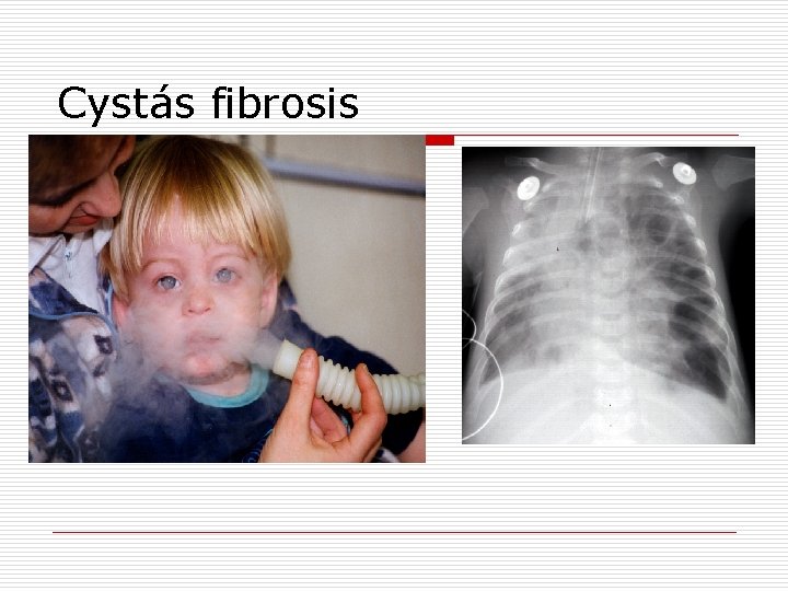 Cystás fibrosis 