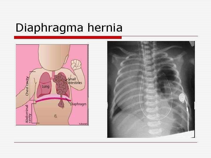 Diaphragma hernia 