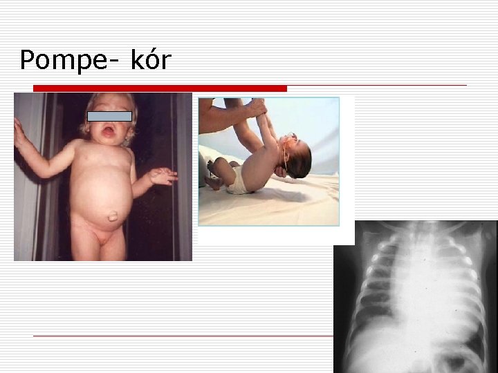 Pompe- kór 