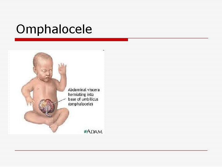 Omphalocele 