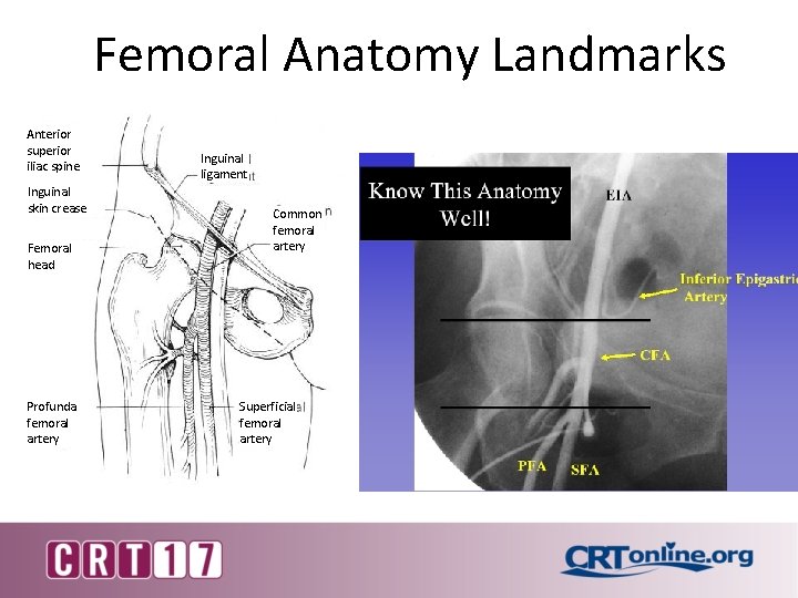 Femoral Anatomy Landmarks Anterior superior iliac spine Inguinal skin crease Femoral head Profunda femoral