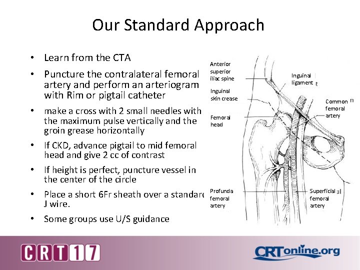 Our Standard Approach • Learn from the CTA • Puncture the contralateral femoral artery