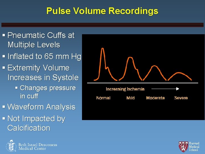 Pulse Volume Recordings § Pneumatic Cuffs at Multiple Levels § Inflated to 65 mm