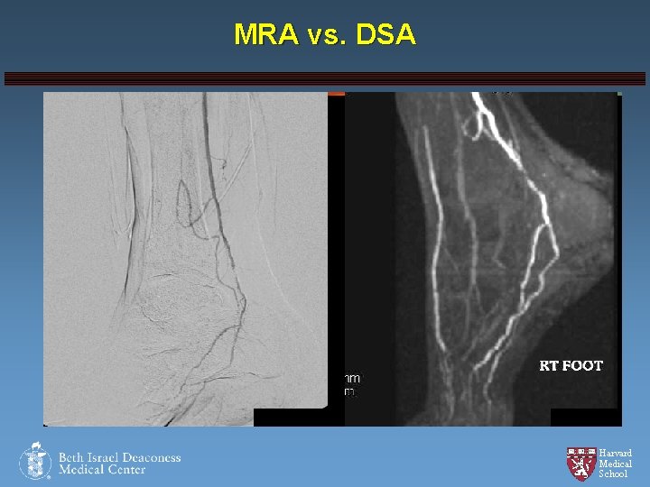 MRA vs. DSA Harvard Medical School 