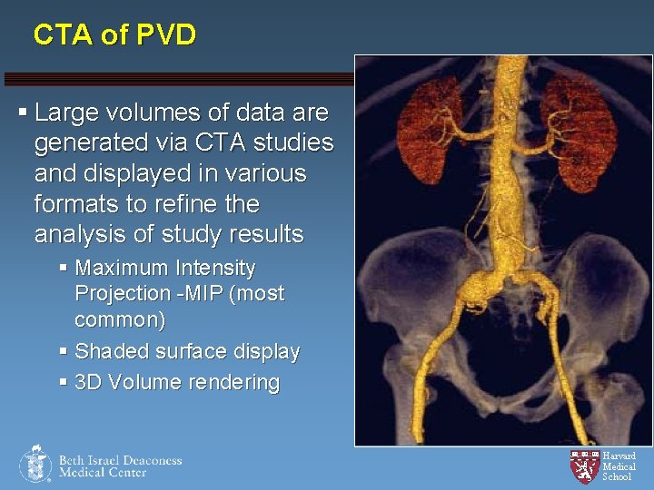 CTA of PVD § Large volumes of data are generated via CTA studies and