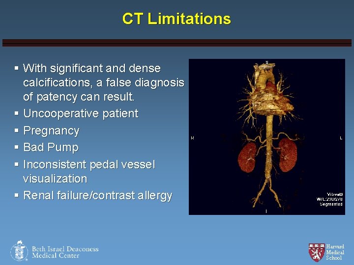 CT Limitations § With significant and dense calcifications, a false diagnosis of patency can