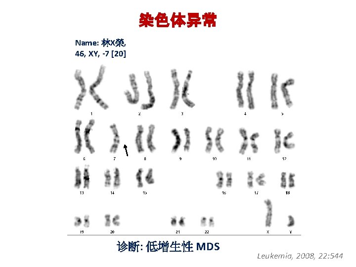 染色体异常 Name: 林X榮, 46, XY, -7 [20] 诊断: 低增生性 MDS Leukemia, 2008, 22: 544