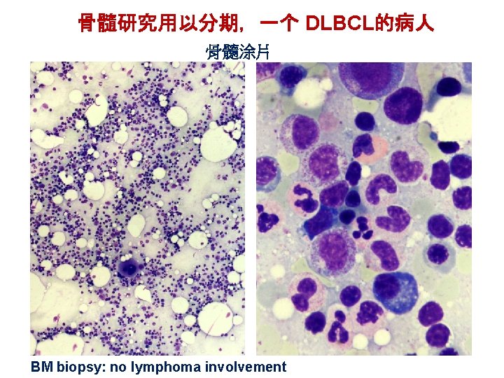 骨髓研究用以分期，一个 DLBCL的病人 骨髓涂片 BM biopsy: no lymphoma involvement 