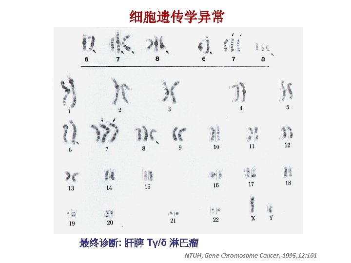 细胞遗传学异常 最终诊断: 肝脾 Tγ/δ 淋巴瘤 NTUH, Gene Chromosome Cancer, 1995, 12: 161 