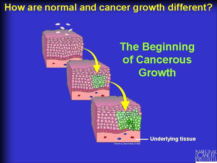 How are normal and cancer growth different? The Beginning of Cancerous Growth Underlying tissue