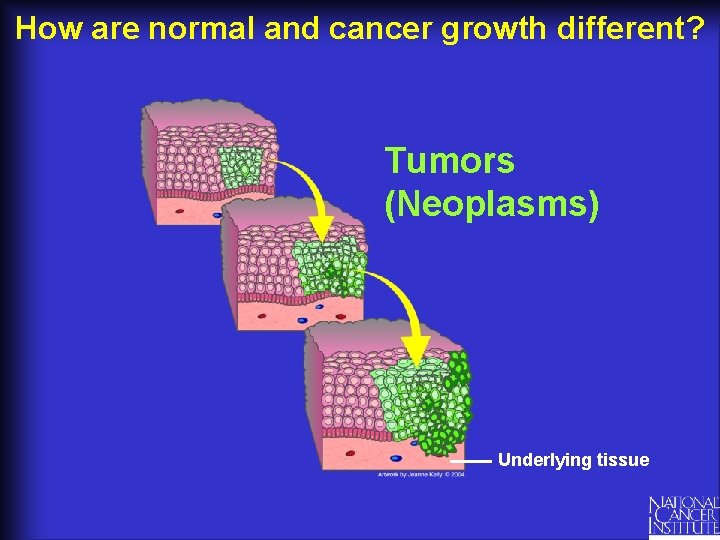 How are normal and cancer growth different? Tumors (Neoplasms) Underlying tissue 